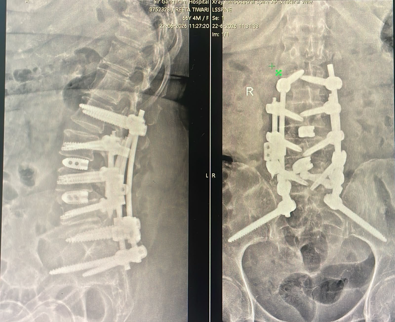 Complex Surgery X-Ray